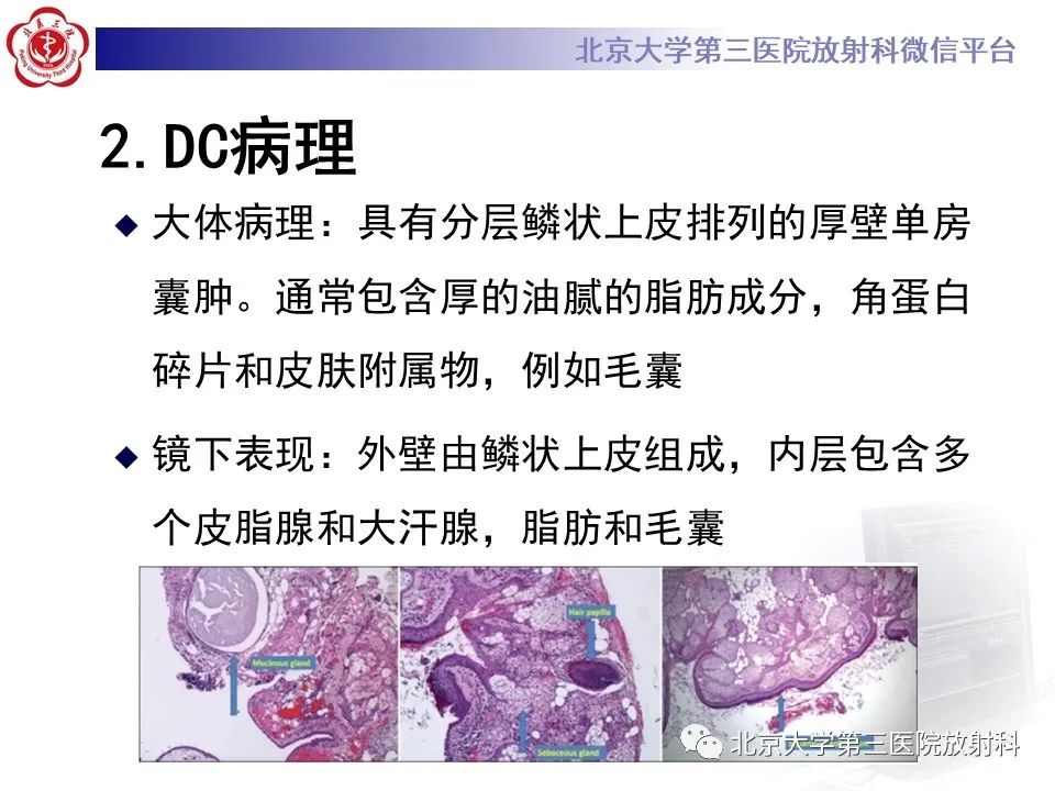 影像PPT - 【PPT】(颅内)皮样囊肿-10