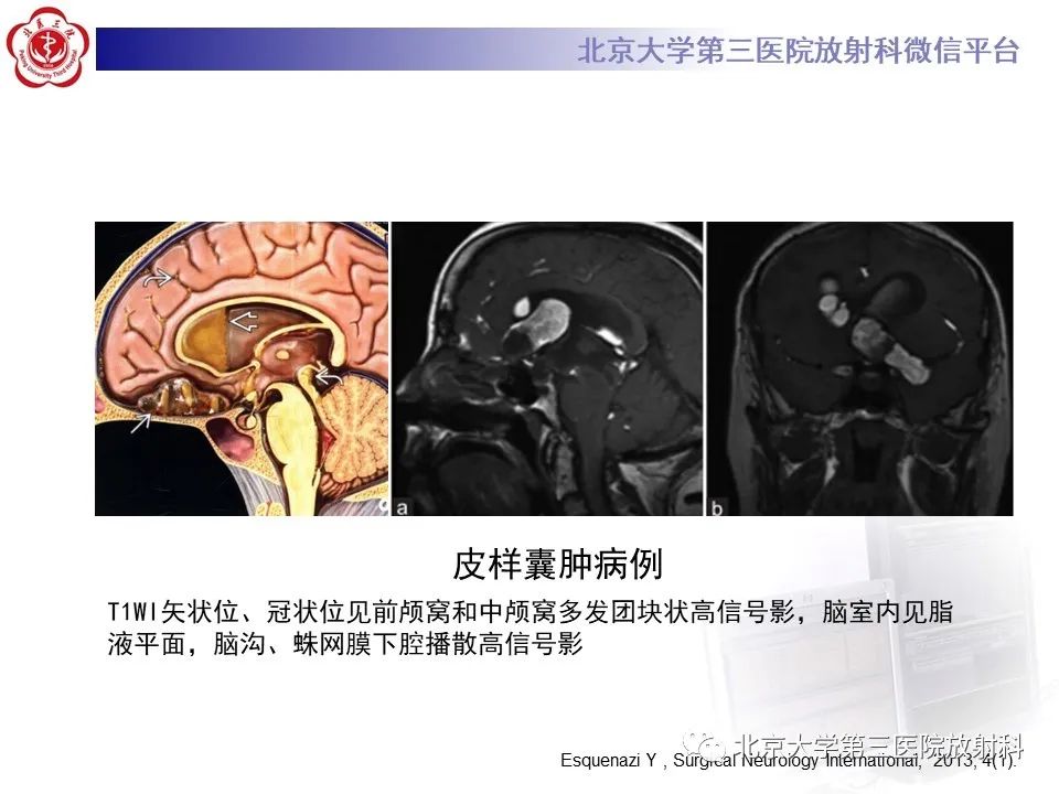 影像PPT - 【PPT】(颅内)皮样囊肿-15