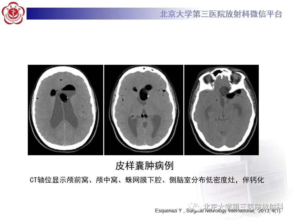影像PPT - 【PPT】(颅内)皮样囊肿-17