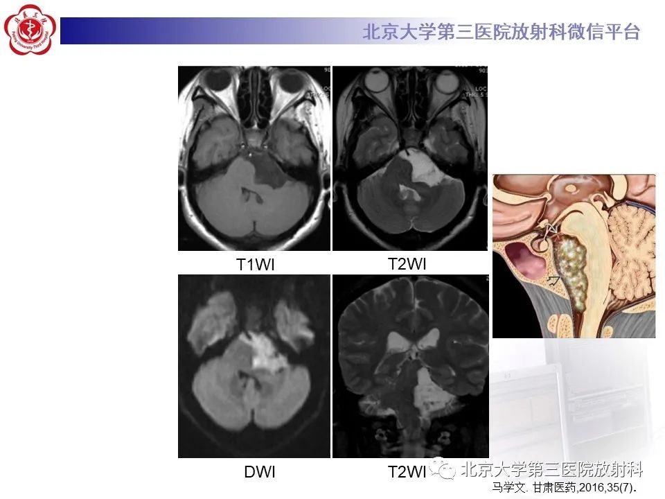 影像PPT - 【PPT】(颅内)皮样囊肿-21