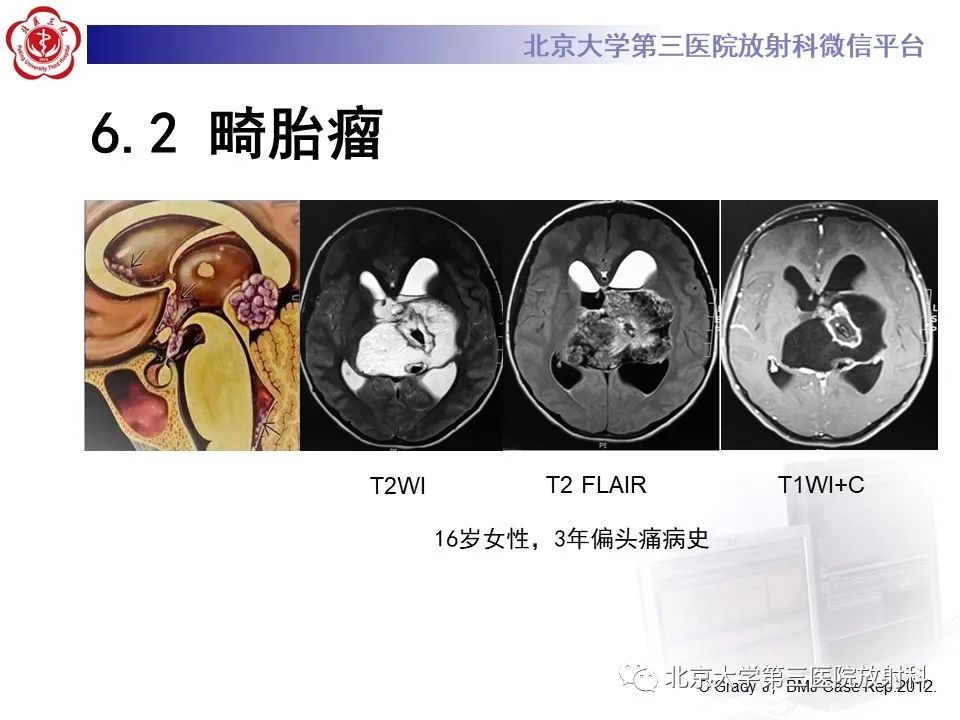影像PPT - 【PPT】(颅内)皮样囊肿-24