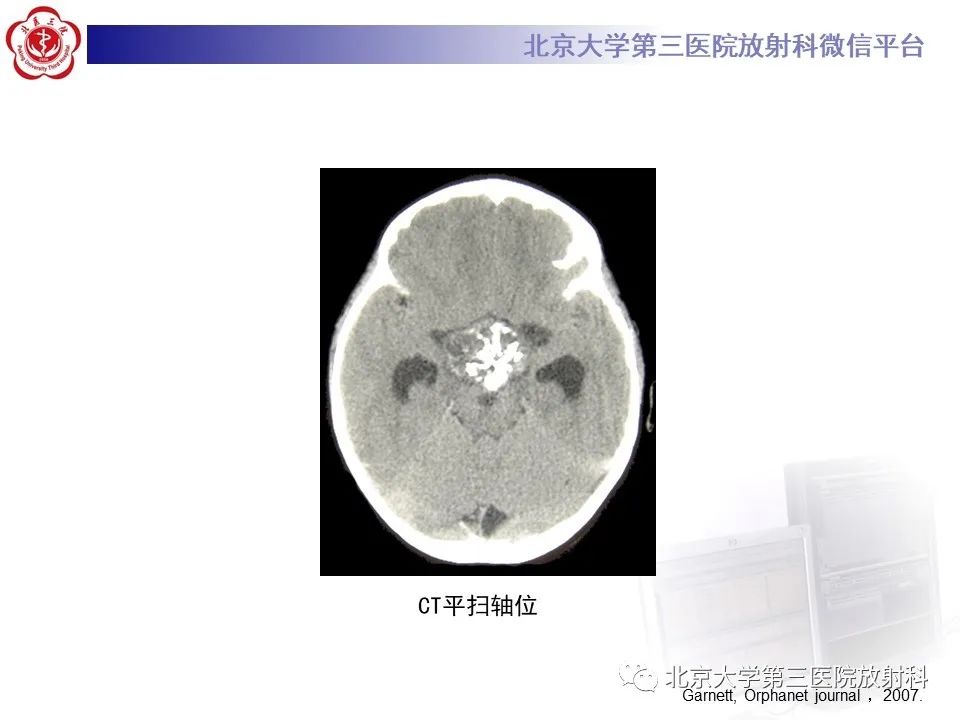 影像PPT - 【PPT】(颅内)皮样囊肿-26