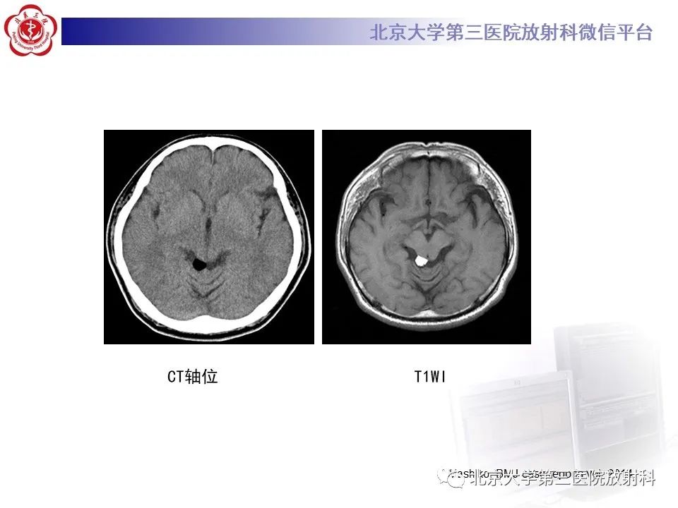 影像PPT - 【PPT】(颅内)皮样囊肿-28