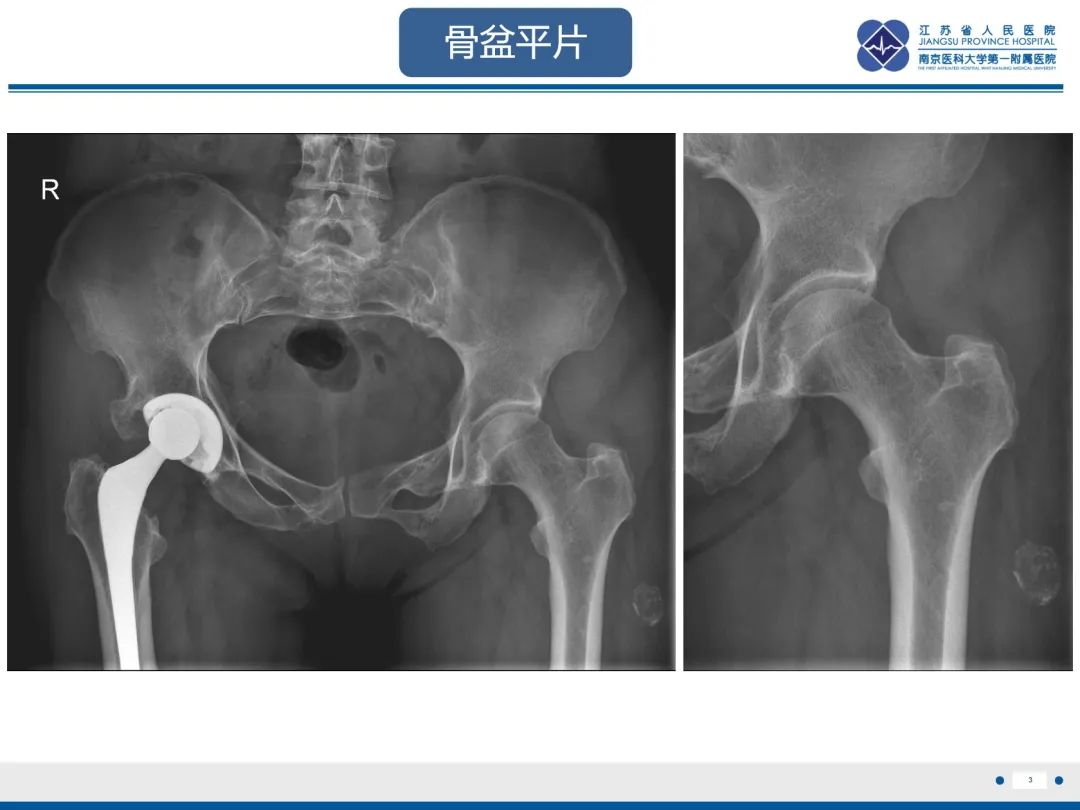 影像PPT - 【PPT】Morel-Lavallée 损伤​-4