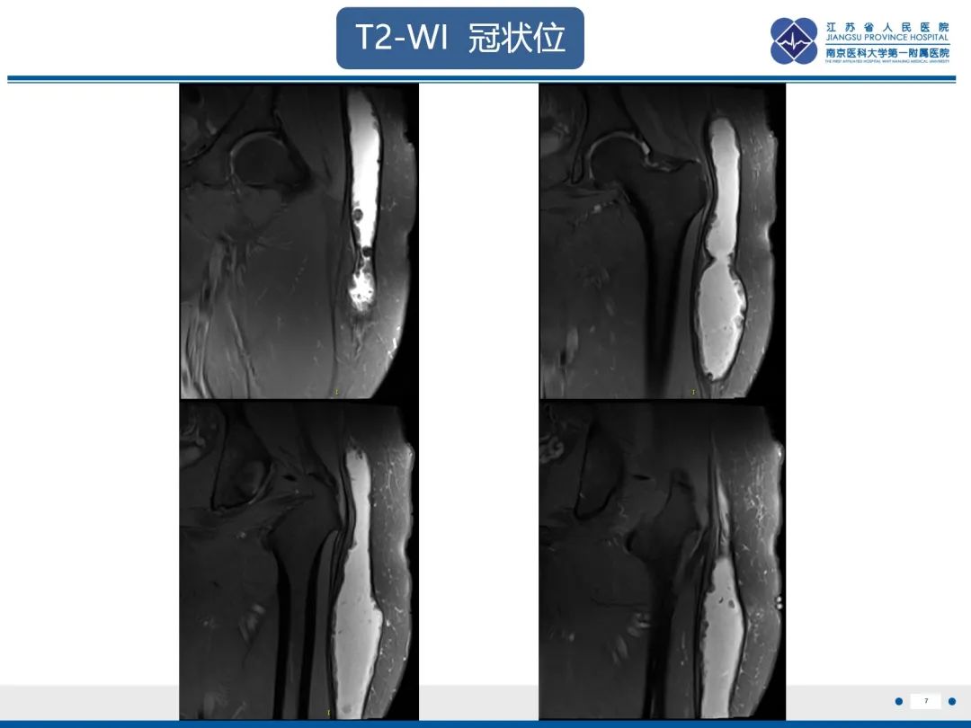 影像PPT - 【PPT】Morel-Lavallée 损伤​-8