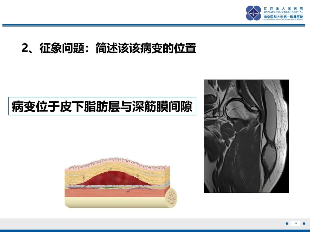 影像PPT - 【PPT】Morel-Lavallée 损伤​-13