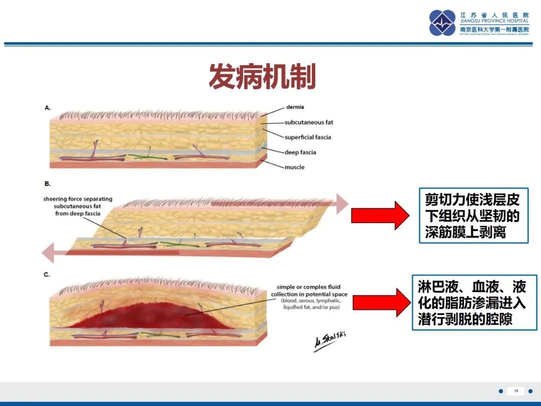 影像PPT - 【PPT】Morel-Lavallée 损伤​-20