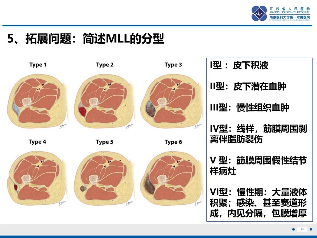 影像PPT - 【PPT】Morel-Lavallée 损伤​-23