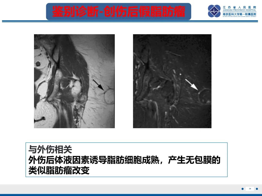 影像PPT - 【PPT】Morel-Lavallée 损伤​-35