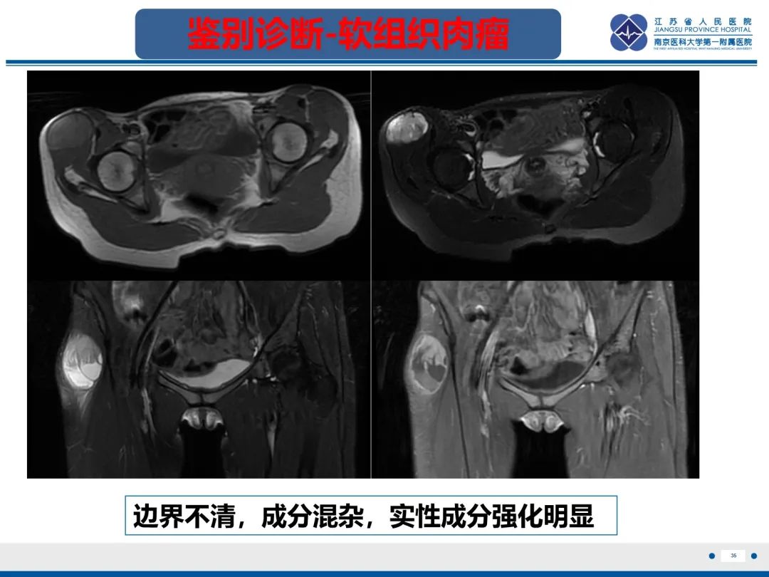 影像PPT - 【PPT】Morel-Lavallée 损伤​-36