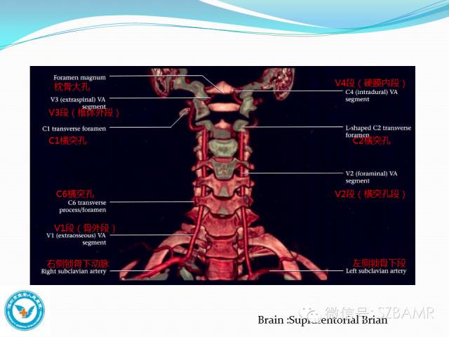 影像PPT - 【PPT】椎-基底动脉系统解剖-8 影像PPT - 【PPT】椎-基底动脉系统解剖-8
