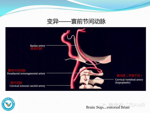 影像PPT - 【PPT】椎-基底动脉系统解剖-15 影像PPT - 【PPT】椎-基底动脉系统解剖-15