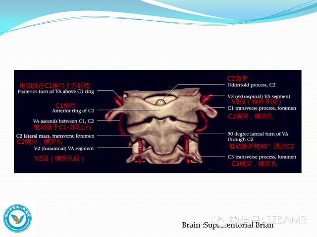 影像PPT - 【PPT】椎-基底动脉系统解剖-16 影像PPT - 【PPT】椎-基底动脉系统解剖-16
