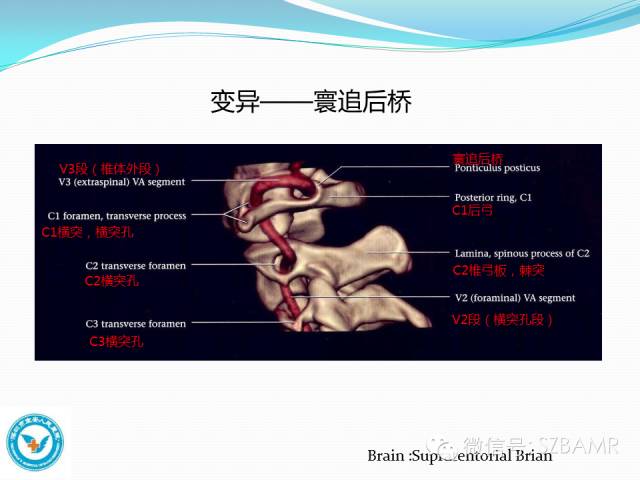 影像PPT - 【PPT】椎-基底动脉系统解剖-17 影像PPT - 【PPT】椎-基底动脉系统解剖-17