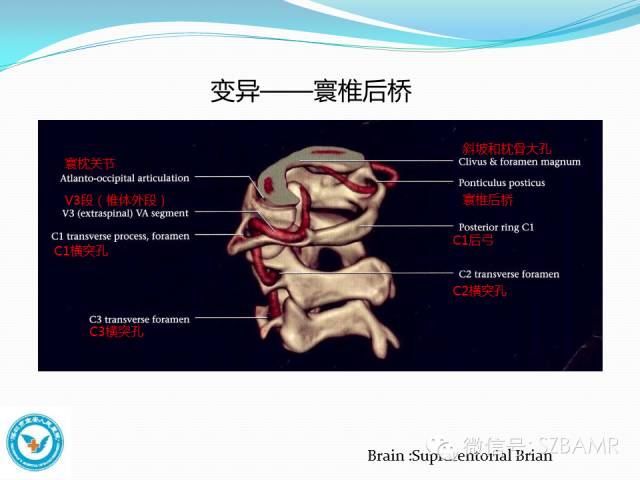 影像PPT - 【PPT】椎-基底动脉系统解剖-18 影像PPT - 【PPT】椎-基底动脉系统解剖-18