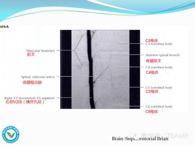 影像PPT - 【PPT】椎-基底动脉系统解剖-19 影像PPT - 【PPT】椎-基底动脉系统解剖-19