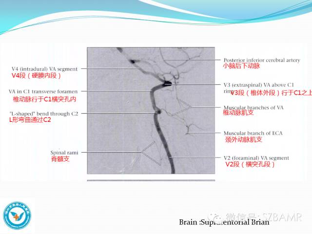 影像PPT - 【PPT】椎-基底动脉系统解剖-20 影像PPT - 【PPT】椎-基底动脉系统解剖-20