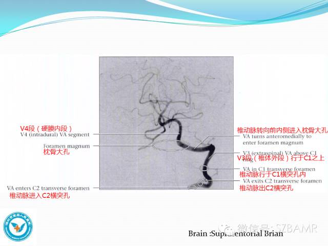 影像PPT - 【PPT】椎-基底动脉系统解剖-21 影像PPT - 【PPT】椎-基底动脉系统解剖-21