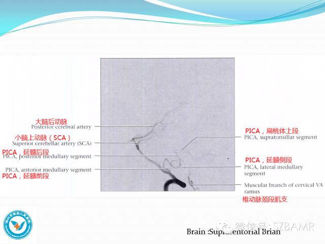 影像PPT - 【PPT】椎-基底动脉系统解剖-22 影像PPT - 【PPT】椎-基底动脉系统解剖-22