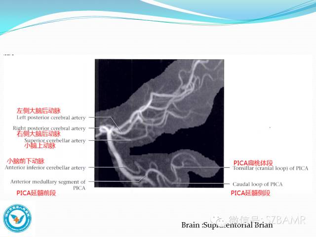 影像PPT - 【PPT】椎-基底动脉系统解剖-25 影像PPT - 【PPT】椎-基底动脉系统解剖-25