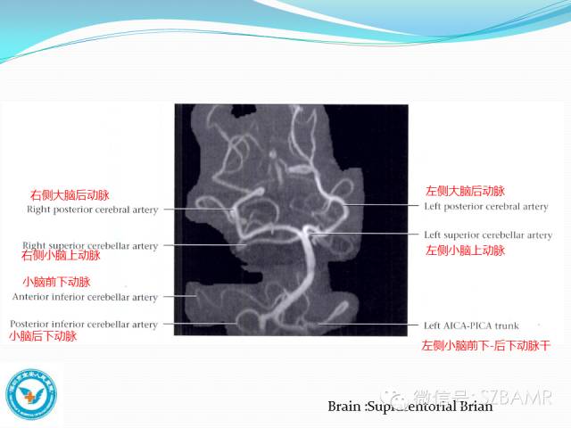 影像PPT - 【PPT】椎-基底动脉系统解剖-26 影像PPT - 【PPT】椎-基底动脉系统解剖-26
