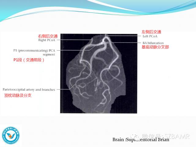 影像PPT - 【PPT】椎-基底动脉系统解剖-27 影像PPT - 【PPT】椎-基底动脉系统解剖-27