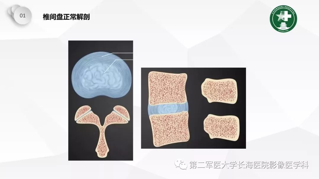 影像PPT - 【PPT】椎间盘退行性病变诊疗-4
