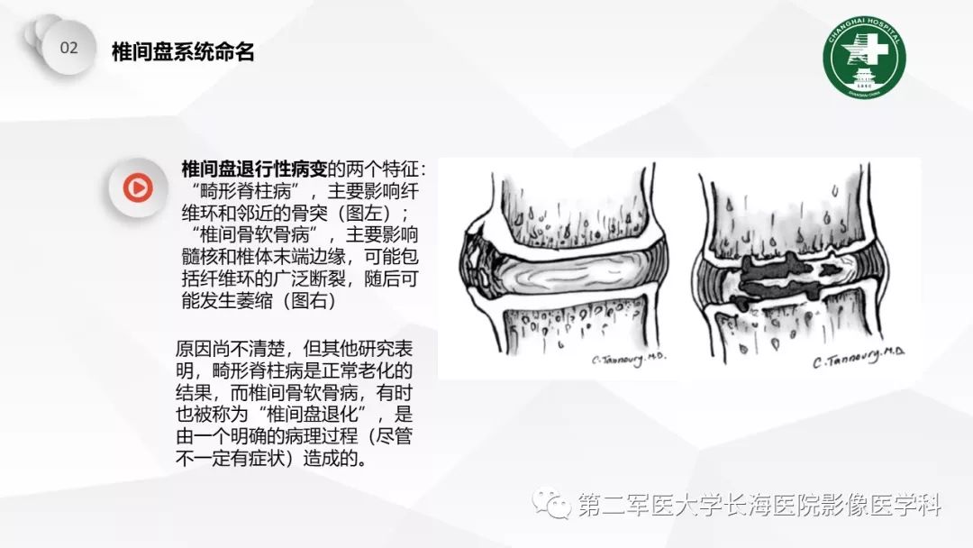 影像PPT - 【PPT】椎间盘退行性病变诊疗-17