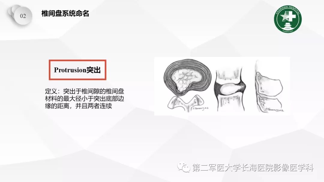影像PPT - 【PPT】椎间盘退行性病变诊疗-21