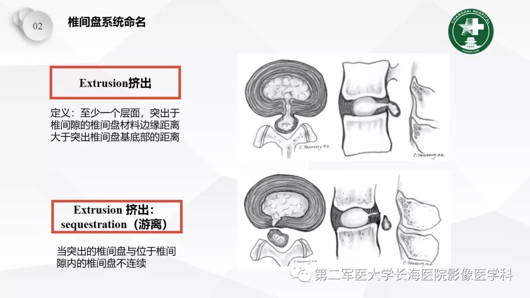 影像PPT - 【PPT】椎间盘退行性病变诊疗-22