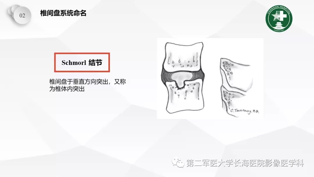 影像PPT - 【PPT】椎间盘退行性病变诊疗-23