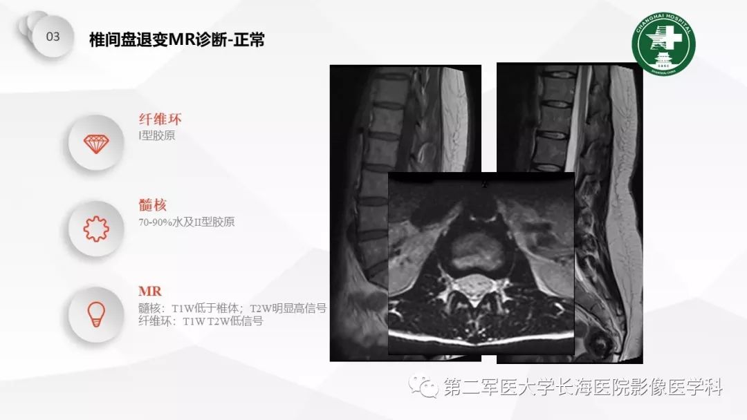 影像PPT - 【PPT】椎间盘退行性病变诊疗-31