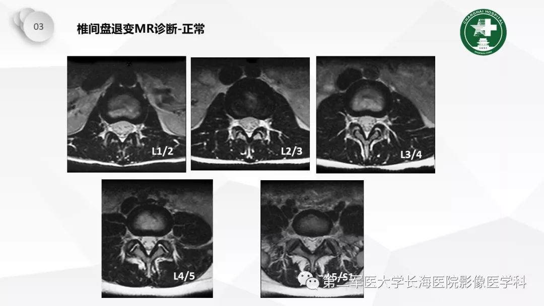 影像PPT - 【PPT】椎间盘退行性病变诊疗-32