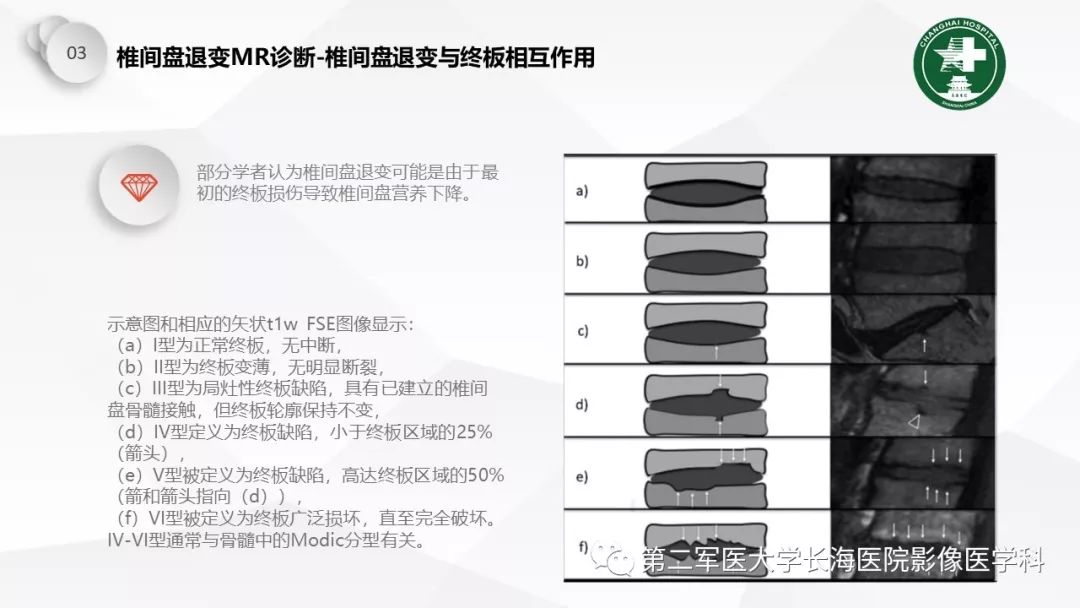 影像PPT - 【PPT】椎间盘退行性病变诊疗-35