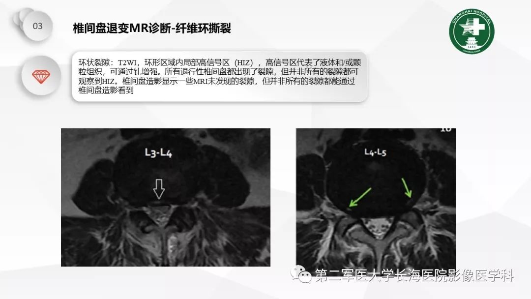 影像PPT - 【PPT】椎间盘退行性病变诊疗-36