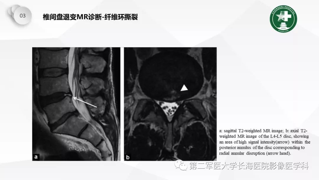影像PPT - 【PPT】椎间盘退行性病变诊疗-37