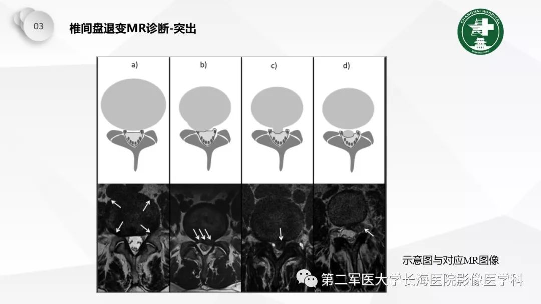 影像PPT - 【PPT】椎间盘退行性病变诊疗-39