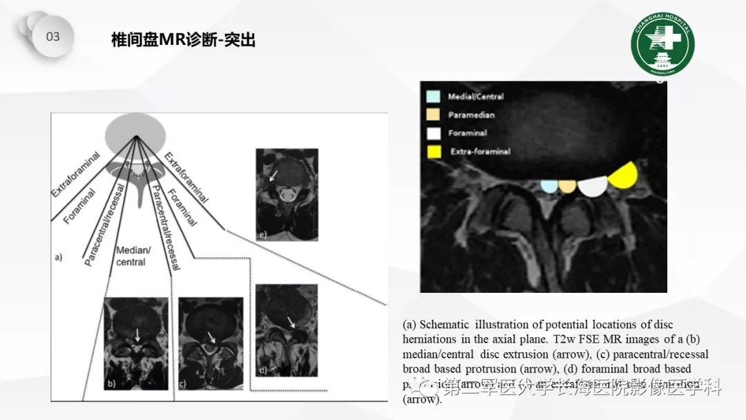 影像PPT - 【PPT】椎间盘退行性病变诊疗-40
