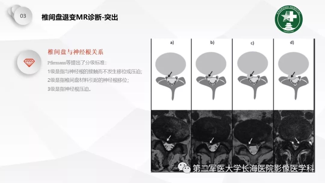 影像PPT - 【PPT】椎间盘退行性病变诊疗-41