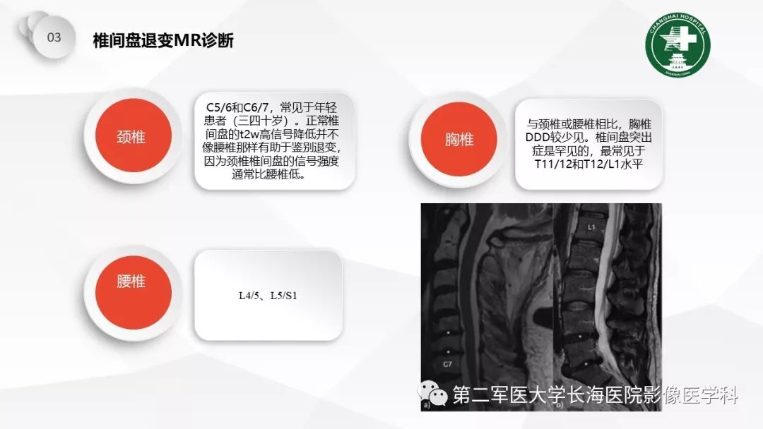 影像PPT - 【PPT】椎间盘退行性病变诊疗-42