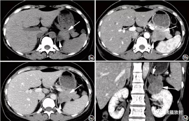 影像PPT - 【病例】肾上腺碰撞瘤1例影像表现-5 影像PPT - 【病例】肾上腺碰撞瘤1例影像表现-5