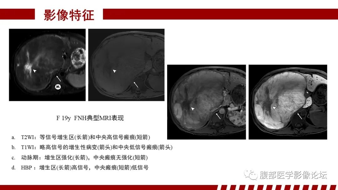 影像PPT - 【PPT】肝胆期高信号的病变影像表现及临床意义-15