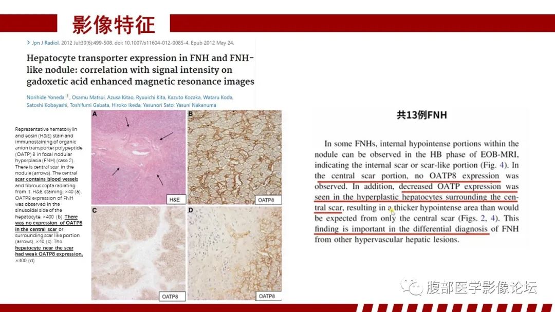 影像PPT - 【PPT】肝胆期高信号的病变影像表现及临床意义-18