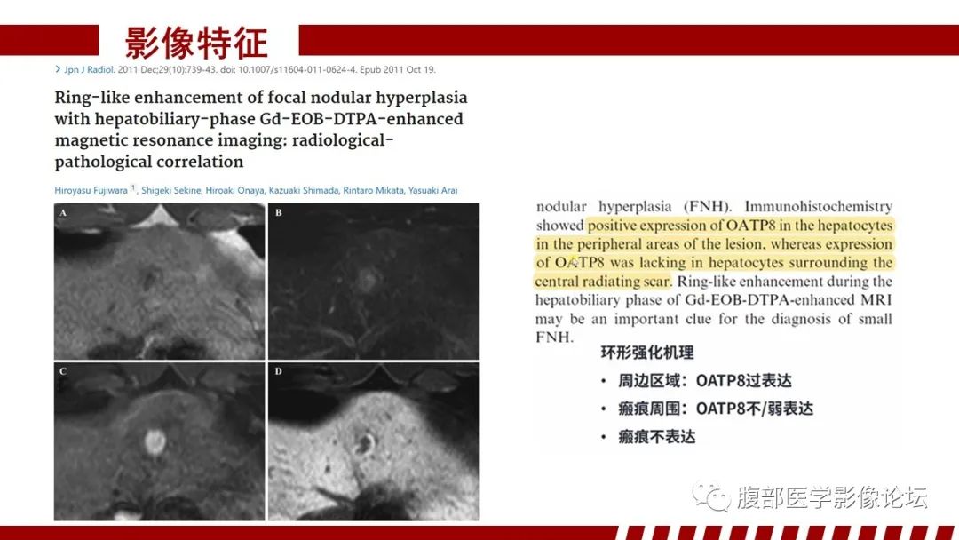 影像PPT - 【PPT】肝胆期高信号的病变影像表现及临床意义-17