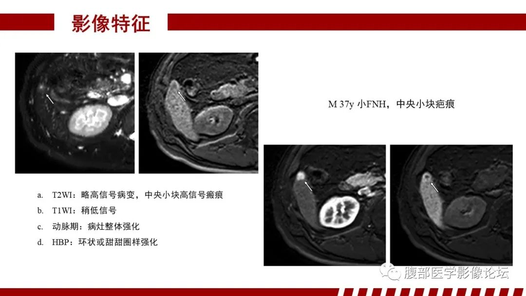 影像PPT - 【PPT】肝胆期高信号的病变影像表现及临床意义-20