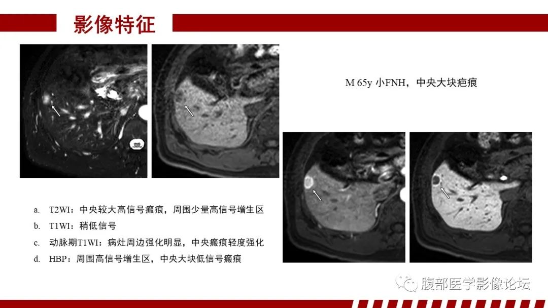 影像PPT - 【PPT】肝胆期高信号的病变影像表现及临床意义-21