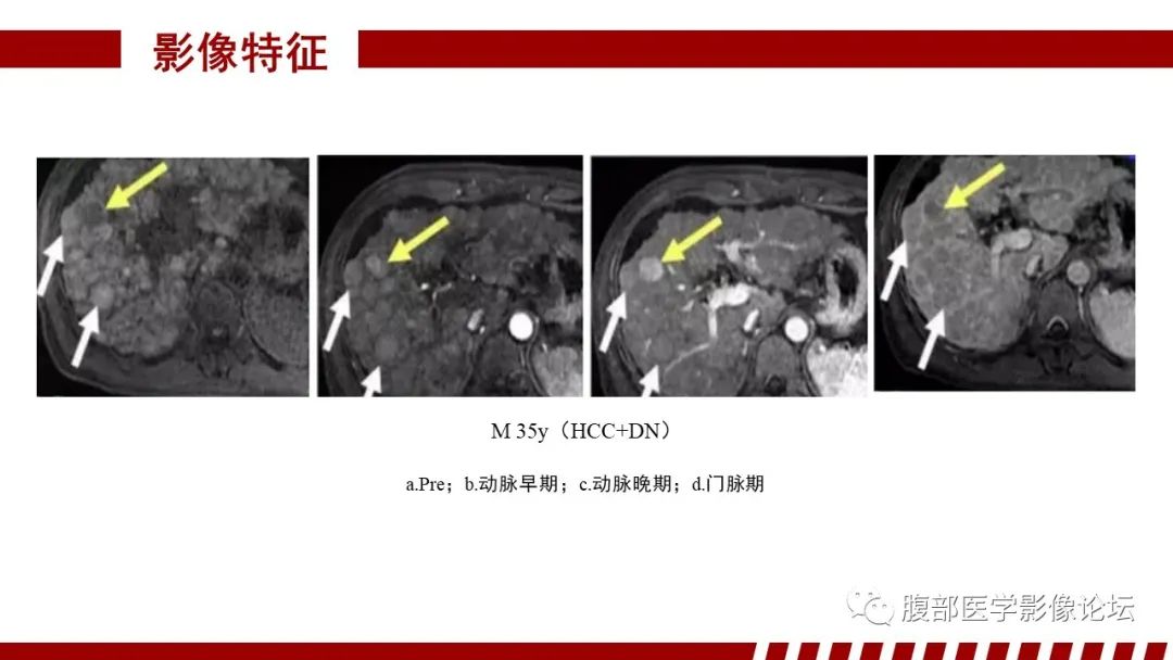 影像PPT - 【PPT】肝胆期高信号的病变影像表现及临床意义-27