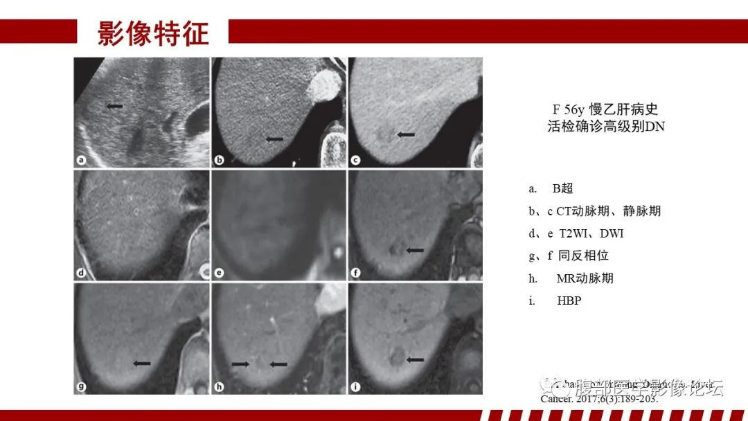 影像PPT - 【PPT】肝胆期高信号的病变影像表现及临床意义-28