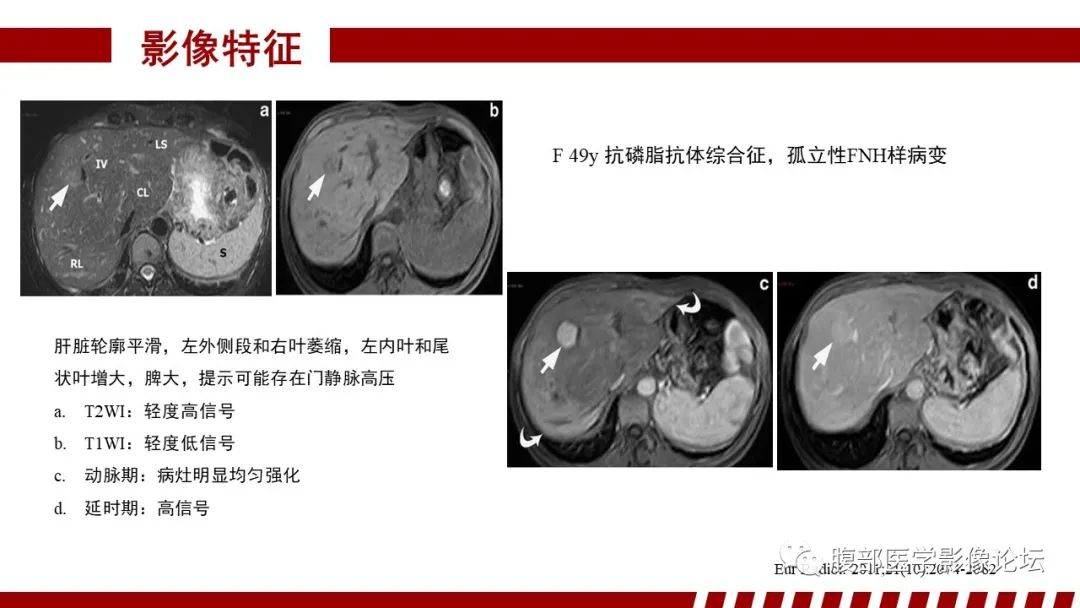 影像PPT - 【PPT】肝胆期高信号的病变影像表现及临床意义-25