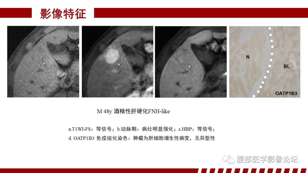 影像PPT - 【PPT】肝胆期高信号的病变影像表现及临床意义-24
